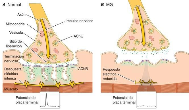 Diferencia entre receptores normales de Ach y receptores de ACh con MG