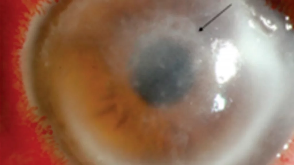 Caso clínico: queratitis por acanthamoeba