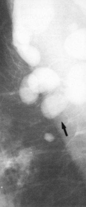 Adenopatias-axilares-mamografia