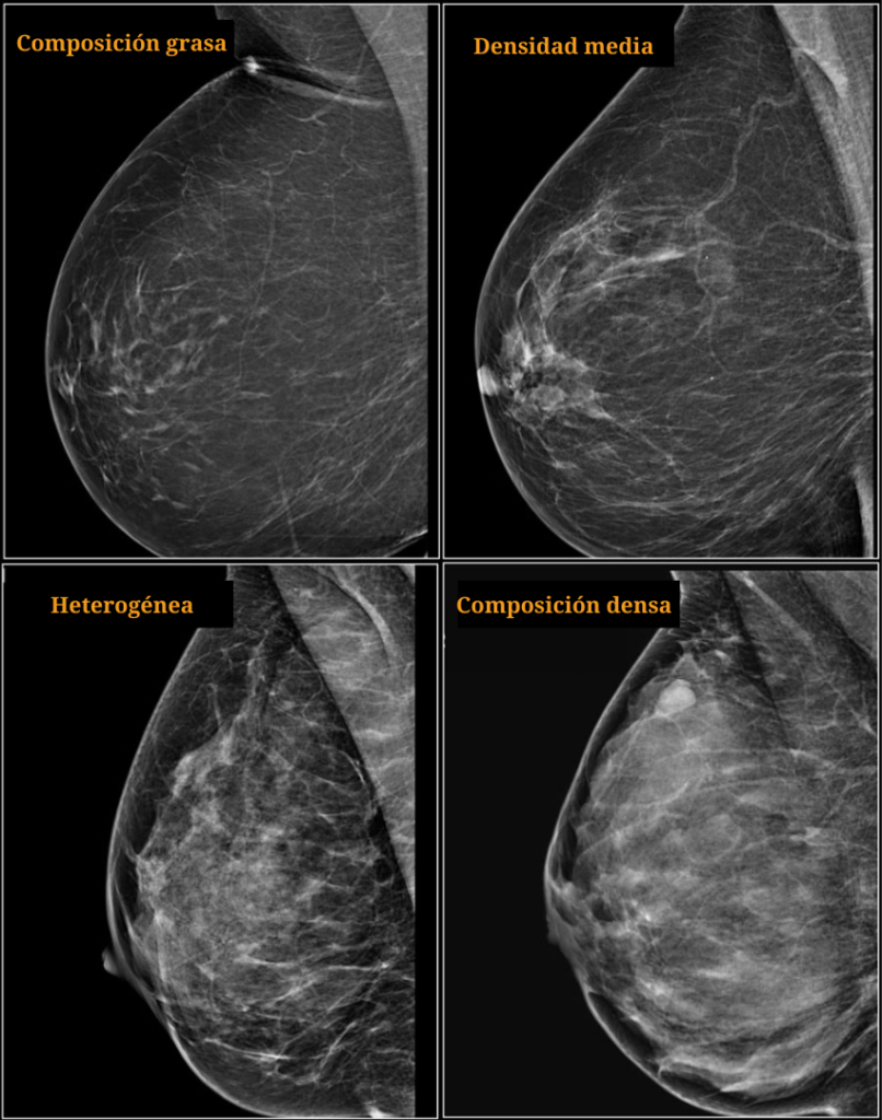 Patron mamografico composicion grasa heterogenea densa sistema bi-rads