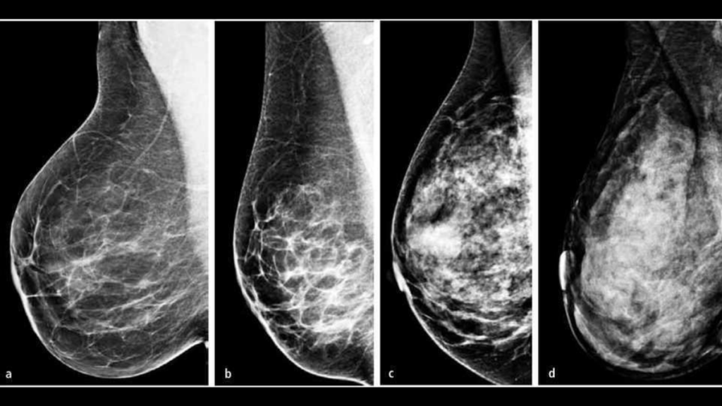 MAMOGRAFIA sistema BI-RADS comointerpretar una mamografia
