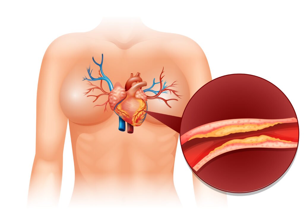 Aterosclerosis