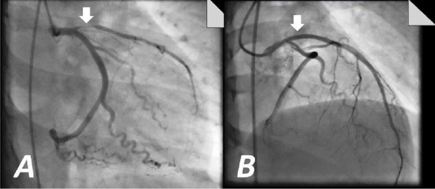 La angiografía coronaria es un examen que suele realizarse previo a una ICP para evaluar la obstrucción de las arterias coronarias