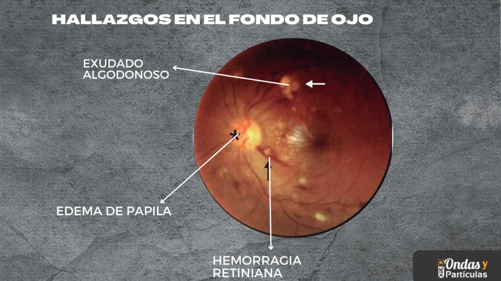 Hallazgos en el fondo de ojo en la hipertension arterial maligna exudados algodonosos, hemorragias retinianas,  edema de papila