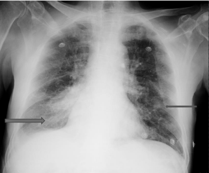 Consolidación multifocal en la radiografía de tórax a causa de bronconeumonía