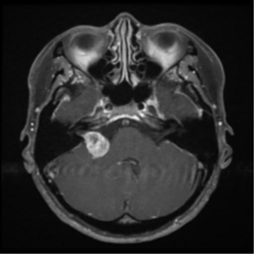Imagen por resonancia magnética donde se evidencia el signo de cono de helado caracteristico del schwannoma vestibular
