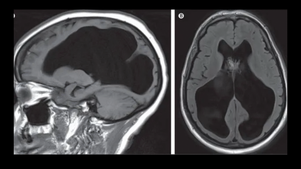 Tomografía axial computarizada (TAC) que muestra un caso de hidrocefalia severa. Las áreas en color oscuro representan líquido cefalorraquídeo (LCR) acumulado en gran volumen dentro de los ventrículos cerebrales. Esta compresión puede desplazar el tejido neuronal hacia la periferia craneal. Esta imagen es ilustrativa y no corresponde al paciente principal mencionado en el artículo.